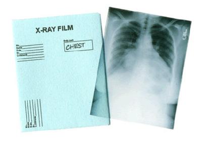 Røntgenbillede